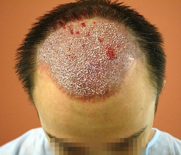 Haartransplantation Forum : Ärzte und Kliniken » 4000FUT, 0-7 Monate